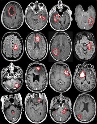 Preoperative Brain Tumor Imaging: Models and Software for Segmentation and Standardized Reporting